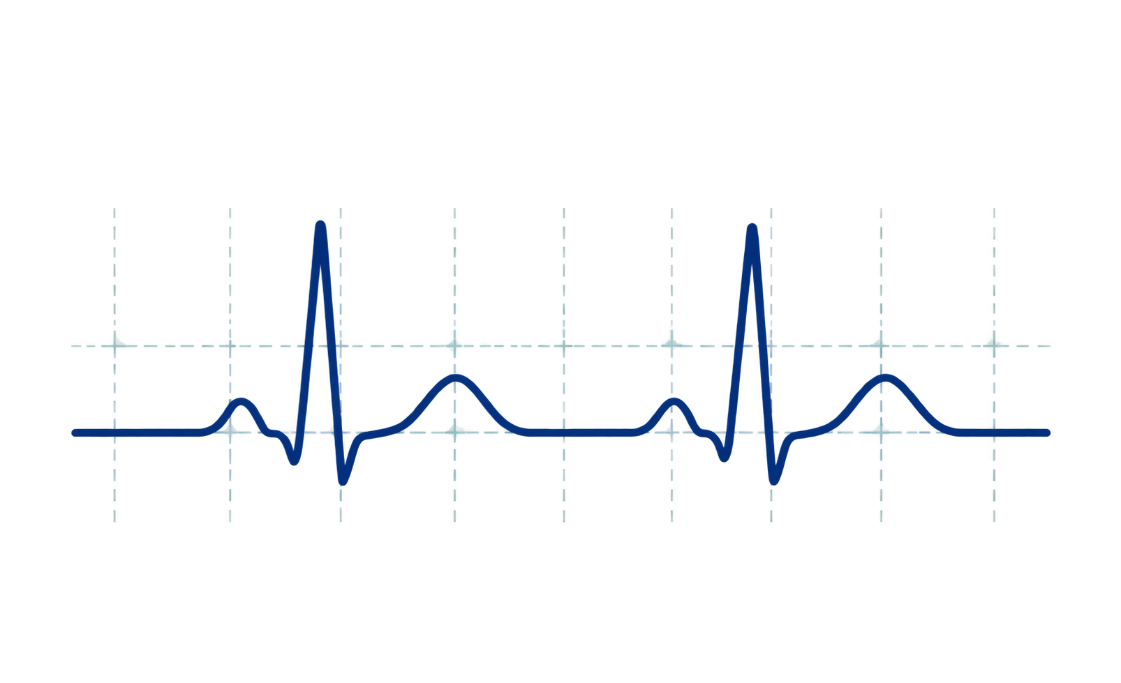 Electrocardiogram signal